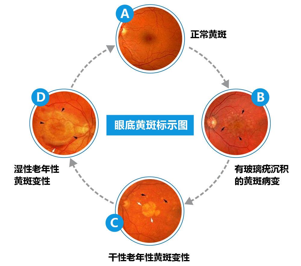 眼底出血