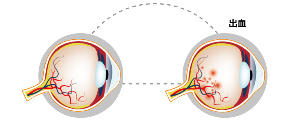 眼底出血